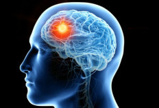 Sakit Kepala Pagi Hari Bisa Jadi Gejala Tumor Otak, Kenali Tanda-Tandanya