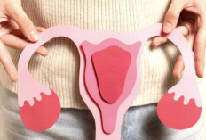 Radioterapi Jadi Solusi Efektif dan Presisi dalam Penanganan Kanker Serviks