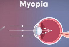 Selain Memakai Kacamata, 2 Metode Ini Efektif untuk Mengatasi Mata Minus!