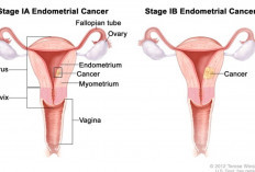 Kanker Endometrium Bisa Terjadi karena Pengaruh Gaya Gidup