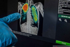 Hambatan Pengobatan TBC: Literasi Rendah dan Stigma Masih Jadi Tantangan