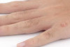 Kenali Tanda Lahir Kecokelatan : Bisa Jadi Gejala Awal Neurofibromatosis Tipe 1 !
